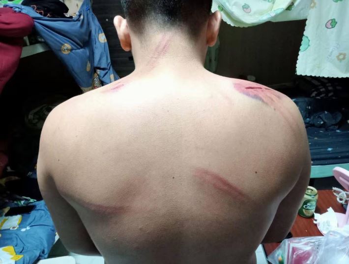 Outra vítima de tráfico (não John) sofreu ferimentos devido a abusos físicos que sofreu num complexo em Myanmar, onde foi forçado a participar num esquema cibernético. (Enviado pela Missão de Justiça Internacional)